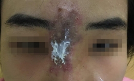 Nữ sinh viên 19 tuổi hoại tử mũi vì tiêm chất làm đầy